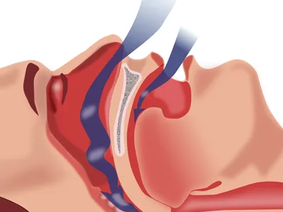 What is Sleep Apnea?